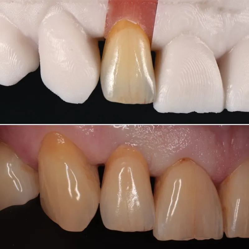 Kroon/brug voorbeeld 1