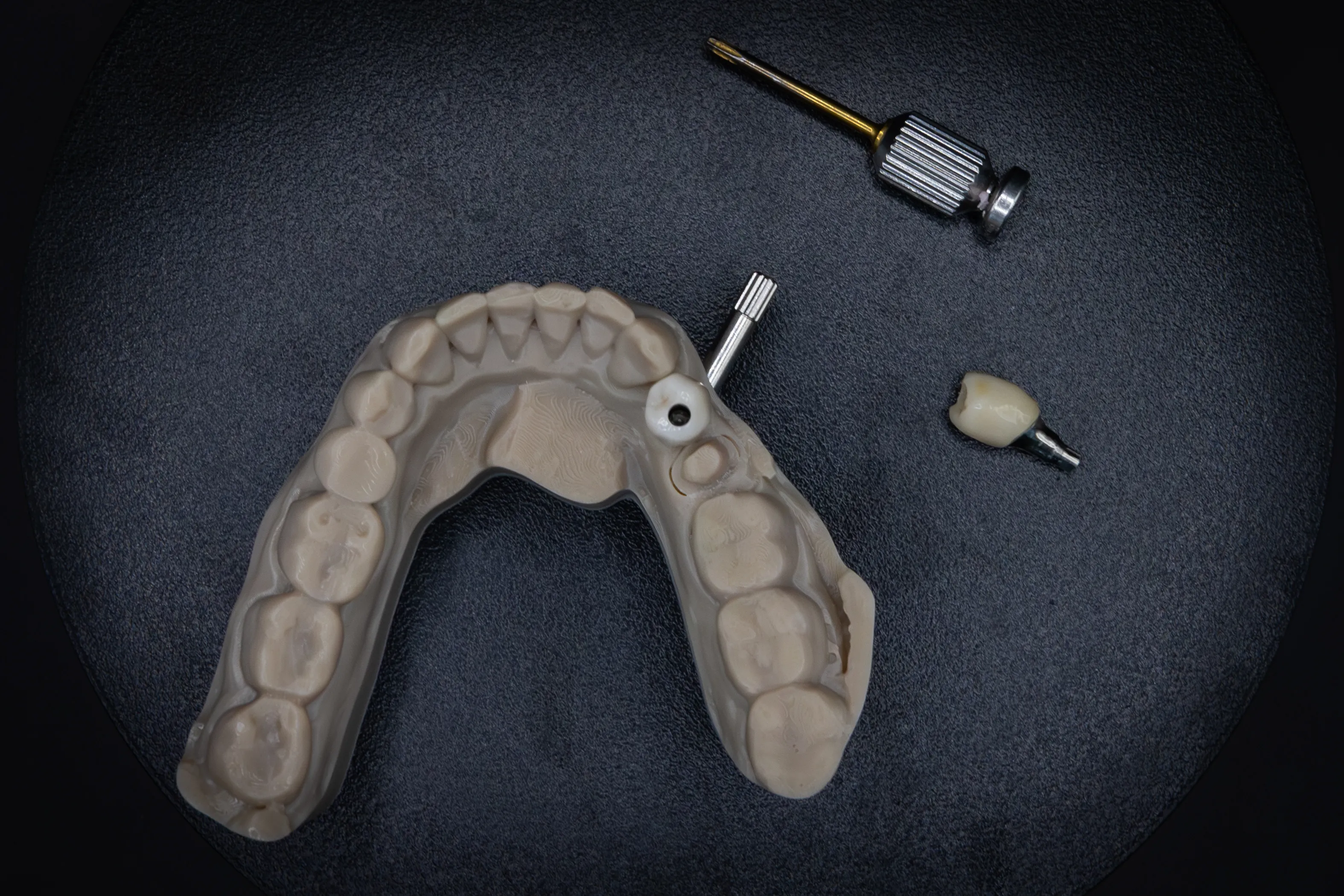 Implantaatwerk voorbeeld 1