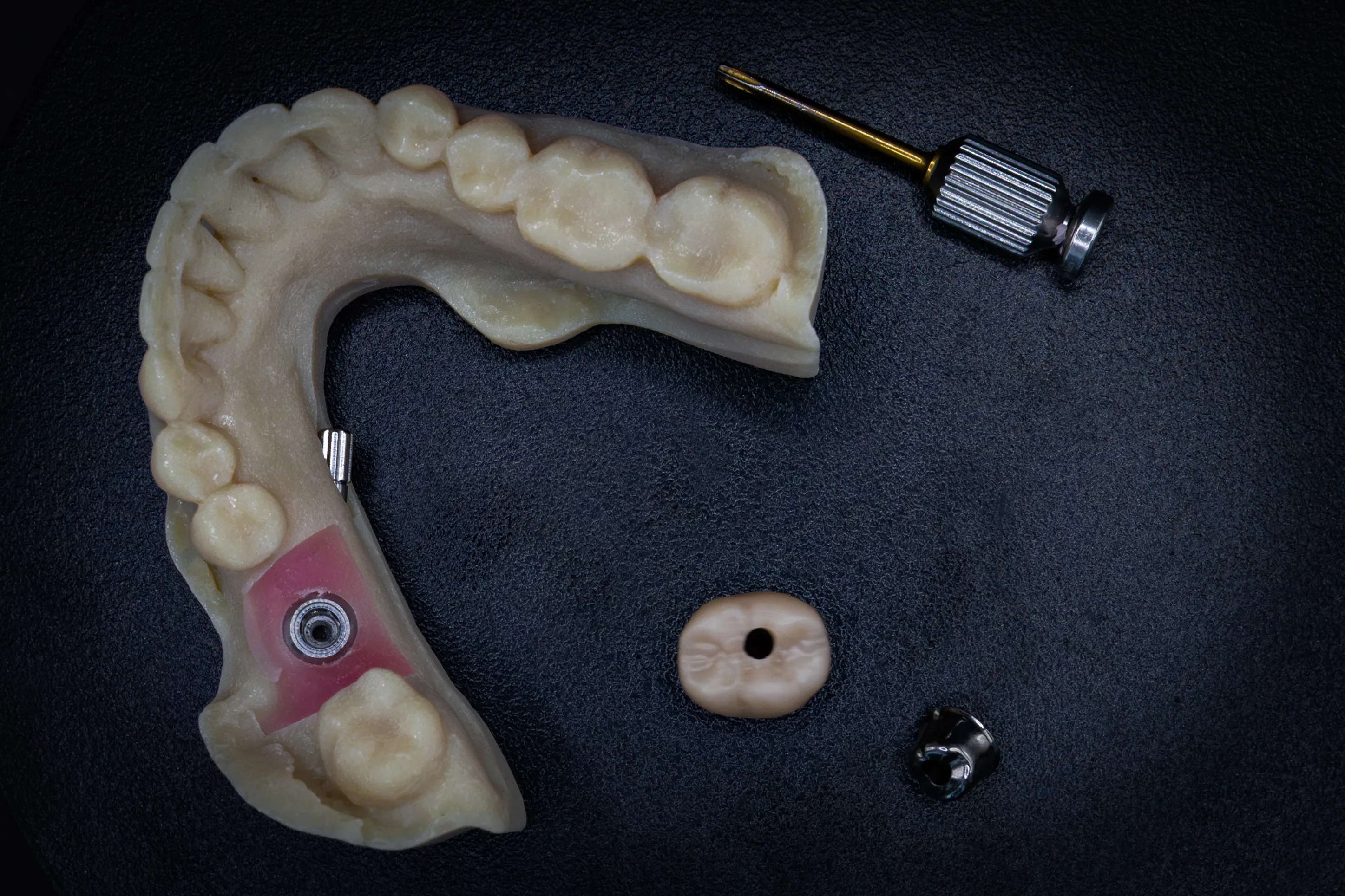 Implantaatwerk voorbeeld 4
