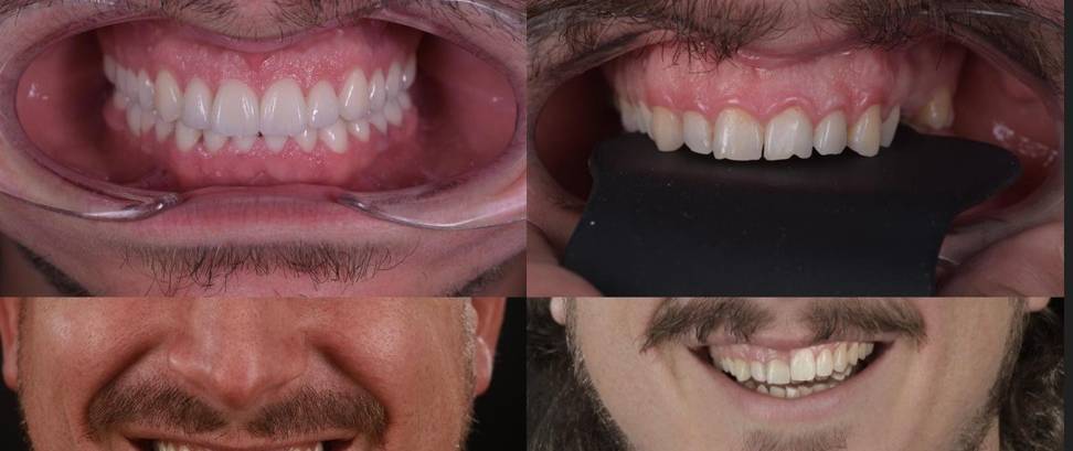 VisionSmile