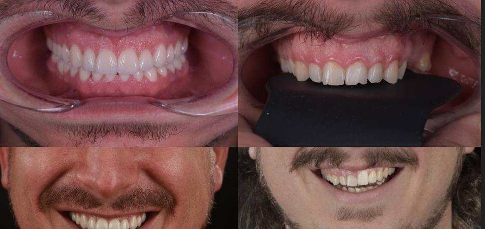 VisionSmile