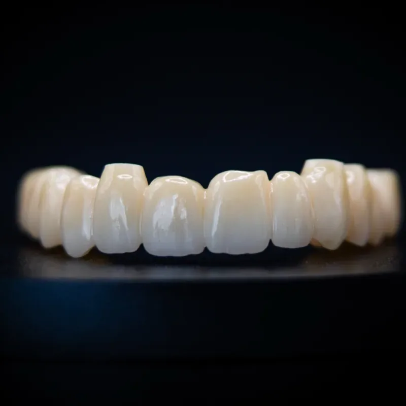 Brug vervaardigd door Confident Dental Lab