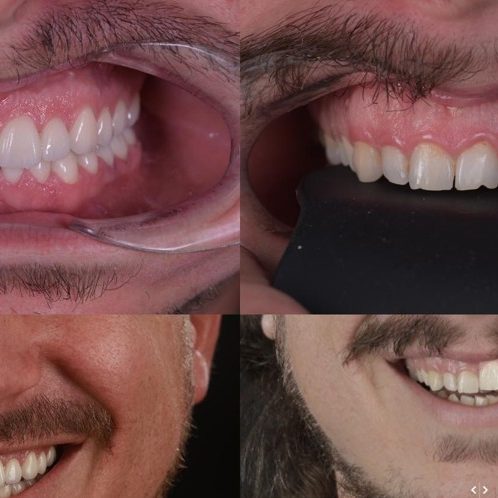 VisionSmile voorbeeld