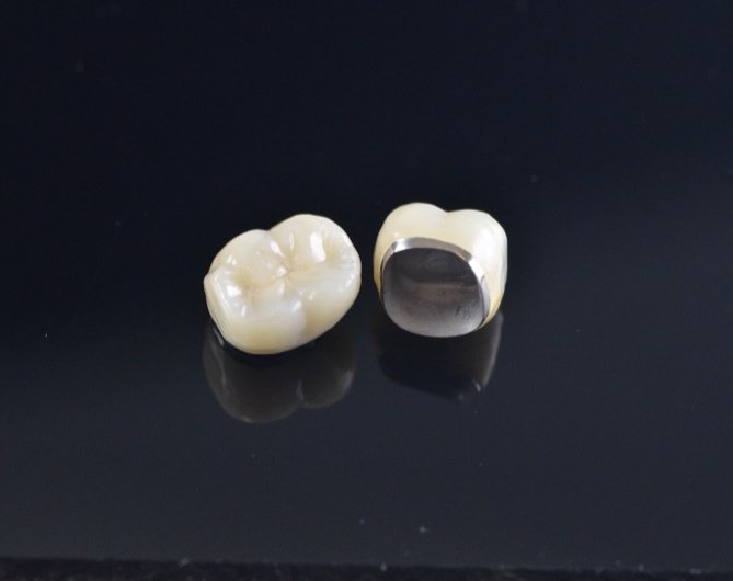 Handgemaakt kroon- en porseleinwerk van Confident Dental Lab