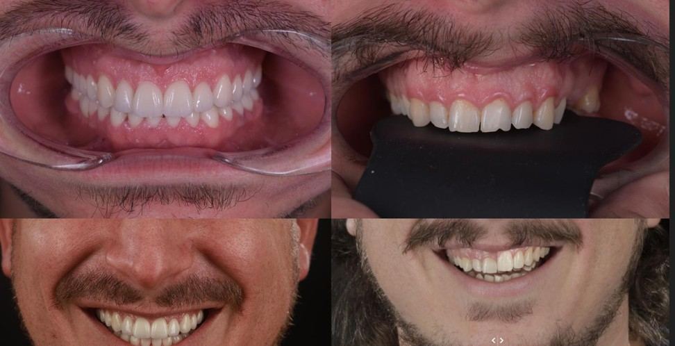 VisionSmile